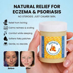 Sanora - Steroid Free Balm For Eczema & Psoriasis