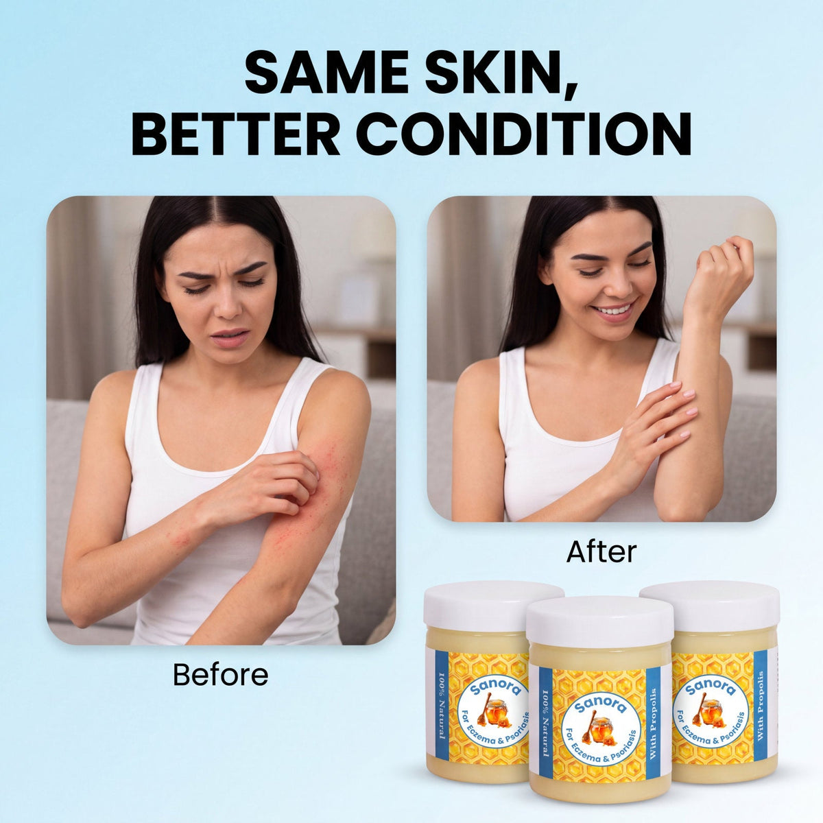 Sanora - Steroid Free Balm For Eczema & Psoriasis